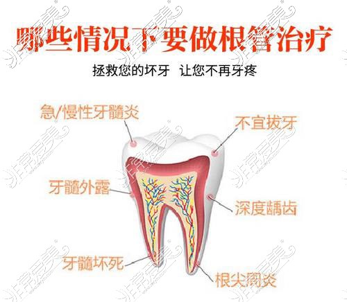 根管治疗示意图