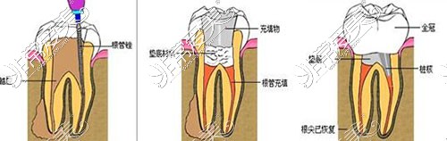 根管治疗示意图