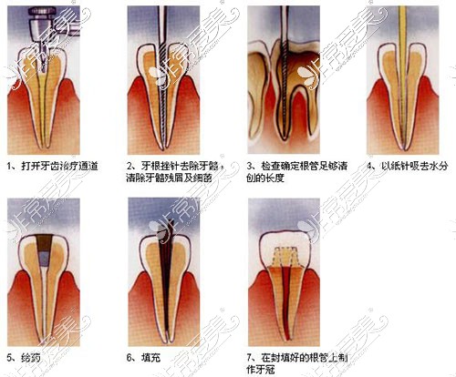 根管治疗示意图