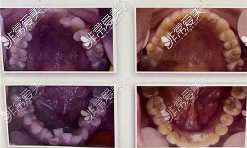 山西众植齿科医院牙齿矫正对比