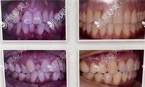 山西众植齿科医院牙齿矫正对比