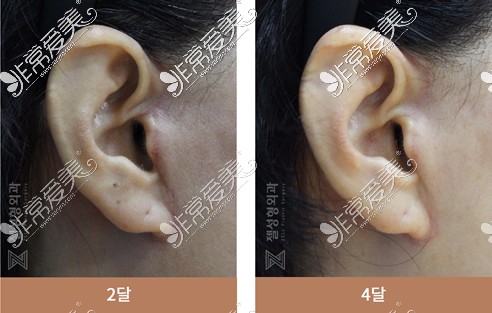 韩国zell整形面部拉皮切口恢复图展示