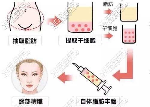 自體脂肪填充面部