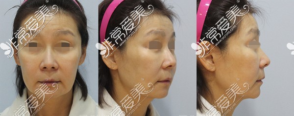 韩国zell整形外科面颈部拉皮手术术前图