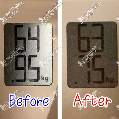 韩国美尔韩方医院粉红丸减肥前后体重