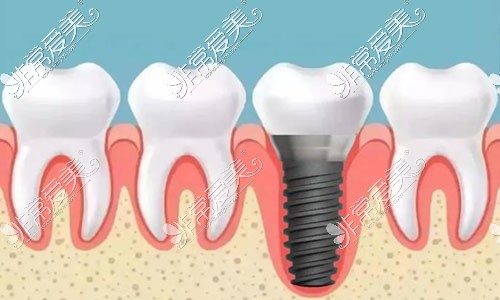 种植牙图片