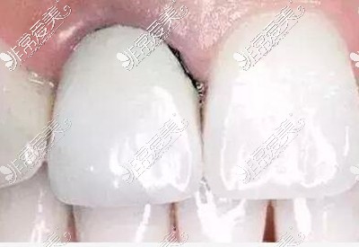 烤瓷牙牙龈黑线图