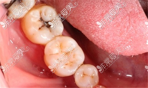 磨牙龋齿治疗