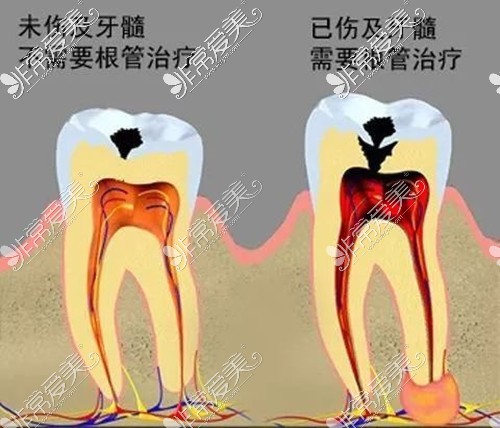 虫牙不补的危害，伤及牙髓就需要根管治疗