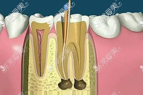 牙髓炎操作示意圖