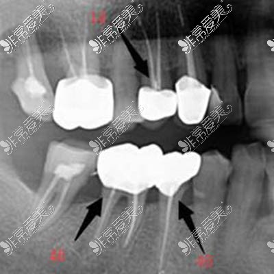 根管治疗后的牙齿ct照