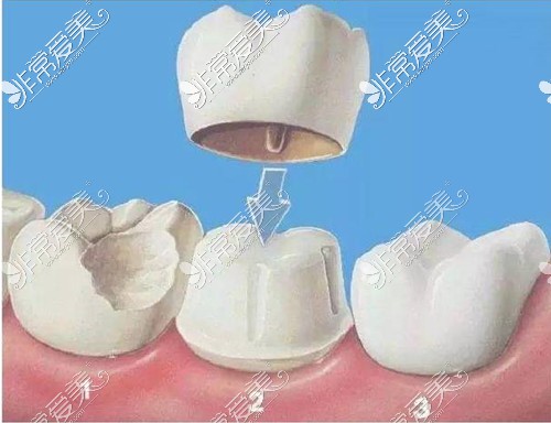 建议根管治疗后戴牙冠保护