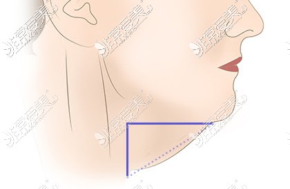 双下巴原来皮肤位置和现在对比