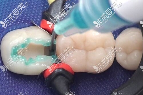 补牙治疗过程图