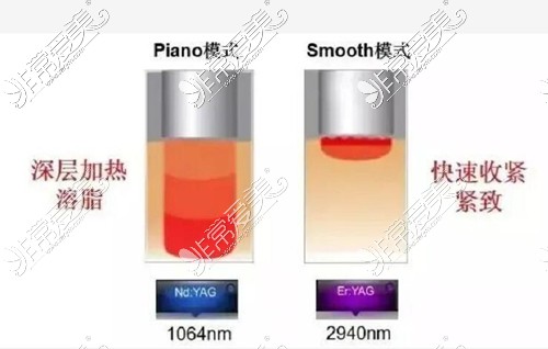 fotona4d欧洲之星功效示意图