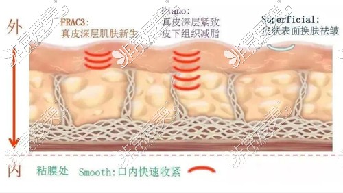 fotona4d欧洲之星是什么,功效,和热玛吉区别等问题汇总解析