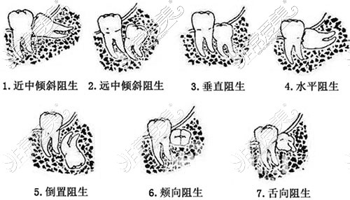 不同的智齿类型