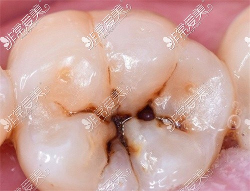 牙齿龋洞