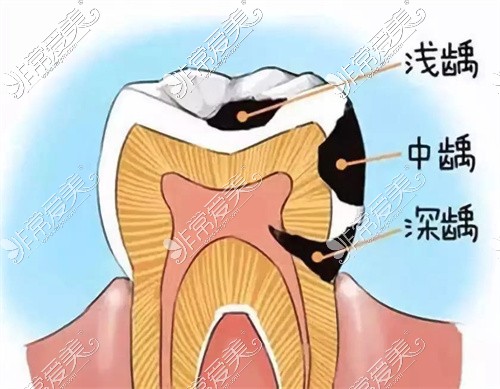 牙齿龋坏卡通图