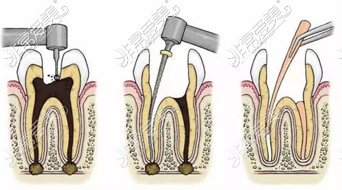 牙齿根管治疗过程图