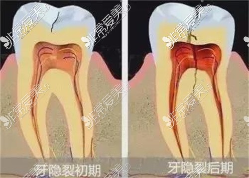 隐裂牙对比图