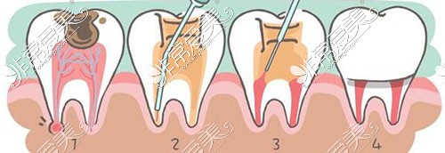 牙齿龋坏了应该怎么办