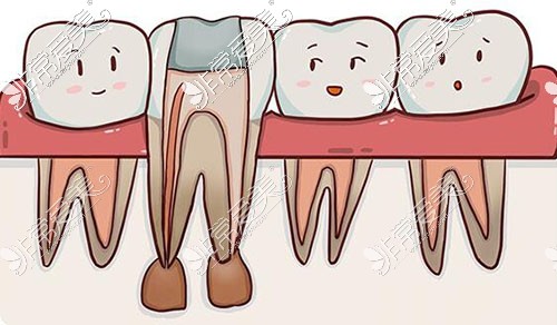 根管治疗卡通图展示照片