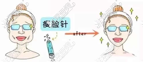 遵义瘦脸价格均价是多少钱？去哪家医院比较好呢？