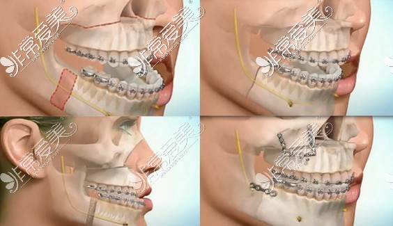 正颌手术方式图
