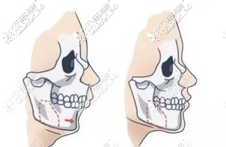 正颌手术前后变化图