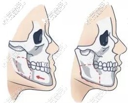 正颌手术前后图片