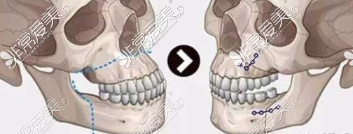 正颌手术骨骼前后变化