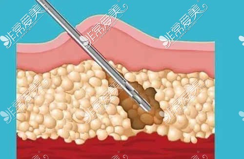 吸脂手术卡通图