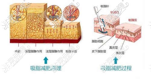 吸脂减肥的变化