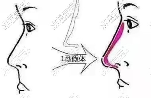 硅胶隆鼻常见的L假体