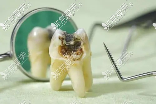 牙髓炎展示图