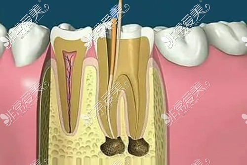 牙髓炎治疗操作示意图