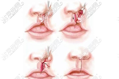 唇腭裂修复手术示意图