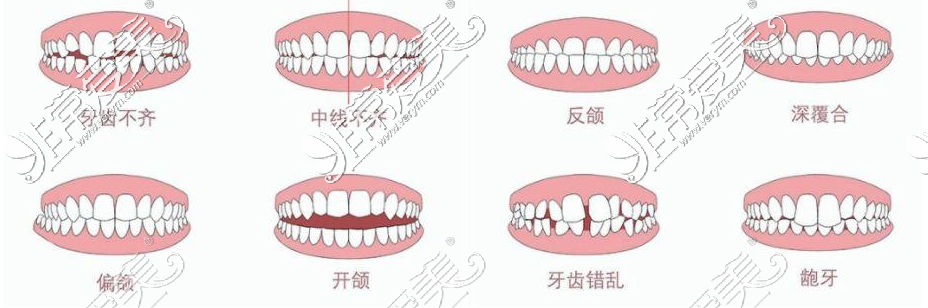 牙齒矯正