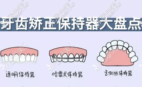 正畸术后常见的三种保持器