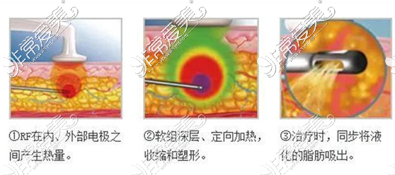 黃金微雕工作原理