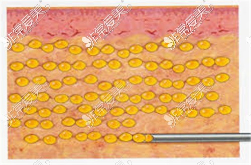 分层脂肪填充方式
