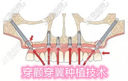 成都科瓦口腔高难度的VIIV穿颧穿翼手术