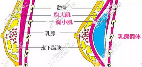 假体丰胸假体的植入位置