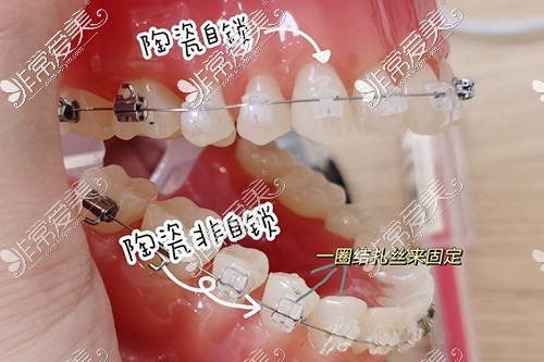 陶瓷自锁托槽及陶瓷非自锁托槽模型图