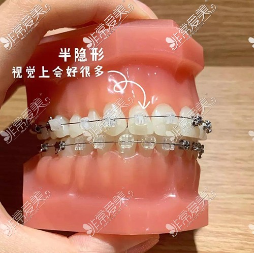 陶瓷隐形牙套模型