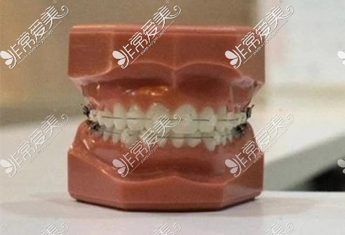 陶瓷半隐形牙齿矫正