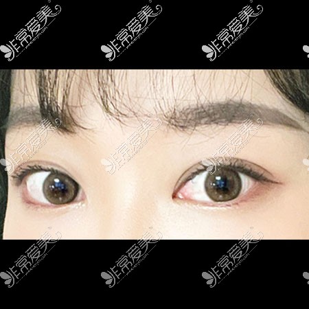 韩国icon双眼皮手术照片