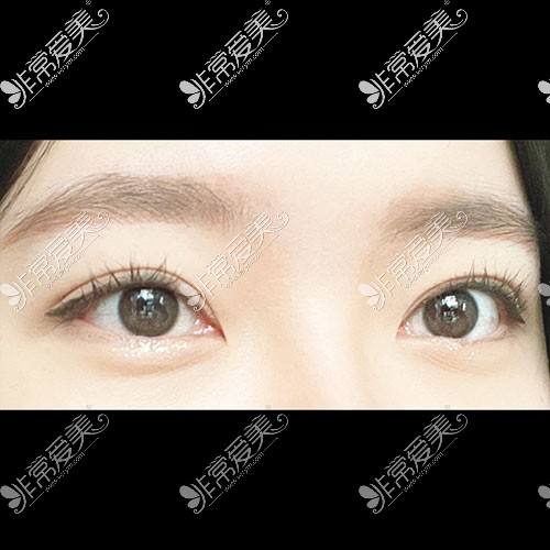韩国icon双眼皮术后图