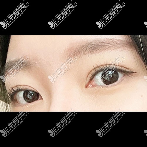 韩国icon双眼皮照片